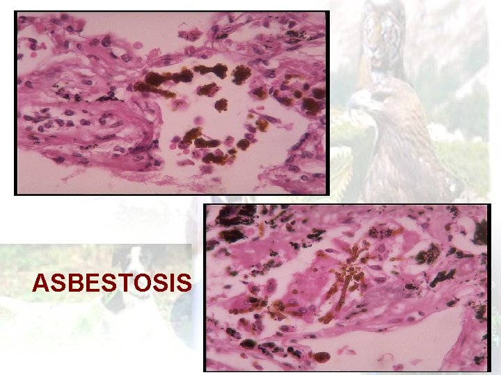 ASBESTOSIS 