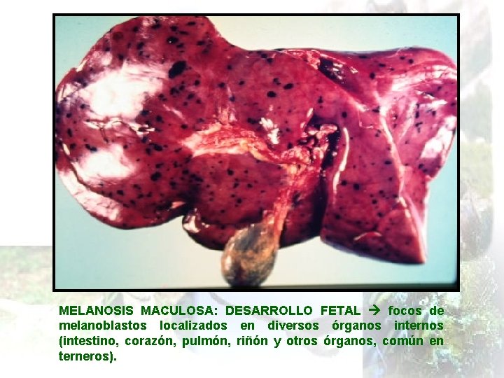 MELANOSIS MACULOSA: DESARROLLO FETAL focos de melanoblastos localizados en diversos órganos internos (intestino, corazón,