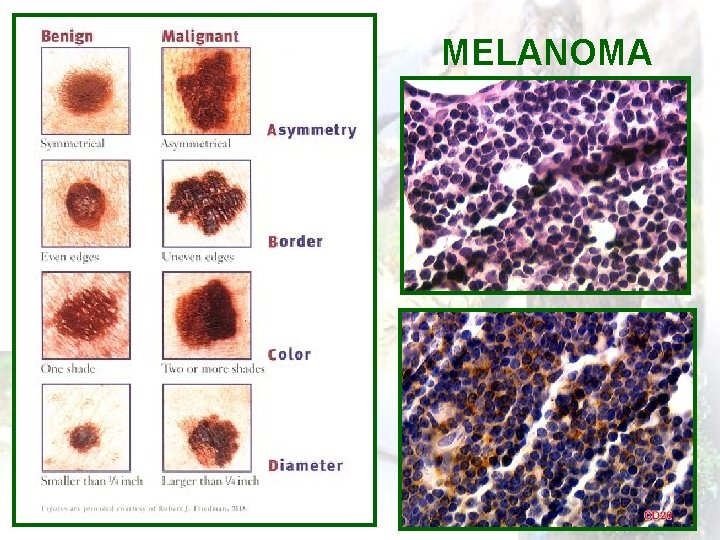 MELANOMA 