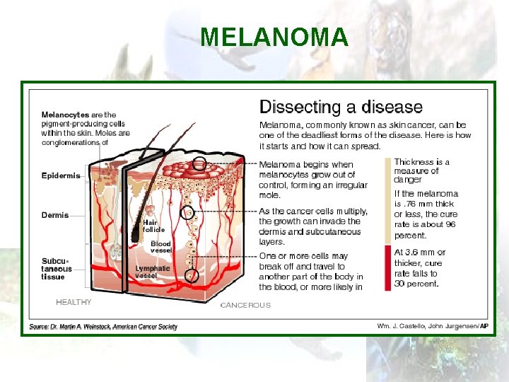 MELANOMA 
