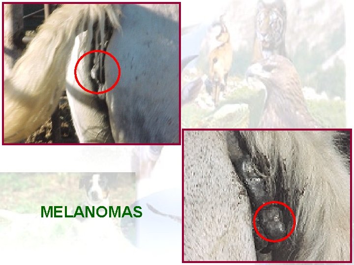 MELANOMAS 