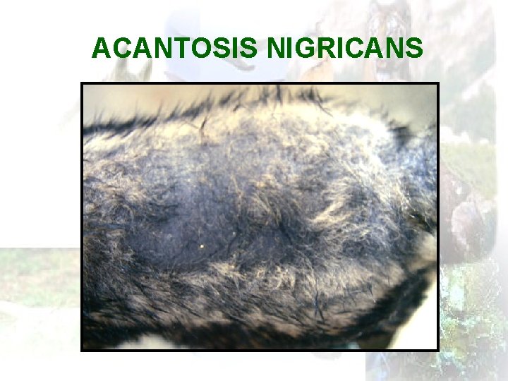 ACANTOSIS NIGRICANS 