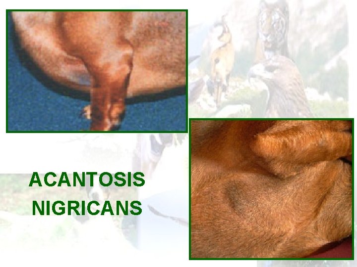 ACANTOSIS NIGRICANS 