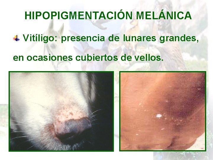 HIPOPIGMENTACIÓN MELÁNICA Vitíligo: presencia de lunares grandes, en ocasiones cubiertos de vellos. 