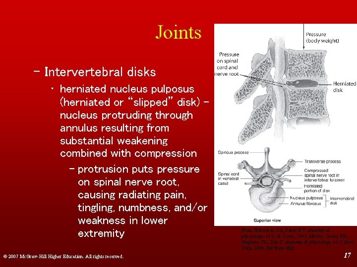 Joints – Intervertebral disks • herniated nucleus pulposus (herniated or “slipped” disk) – nucleus