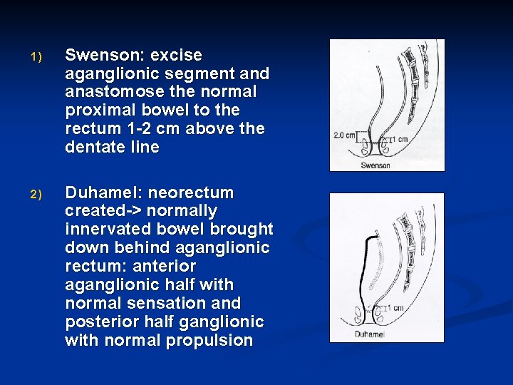 1) Swenson: excise aganglionic segment and anastomose the normal proximal bowel to the rectum