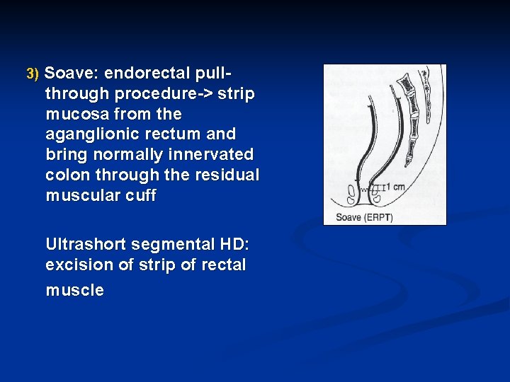 3) Soave: endorectal pull- through procedure-> strip mucosa from the aganglionic rectum and bring