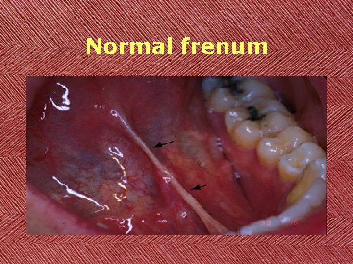Normal frenum 