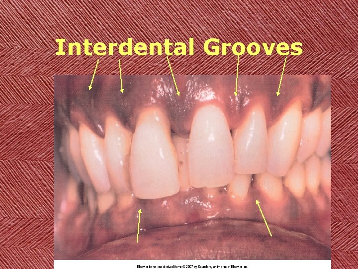 Interdental Grooves 