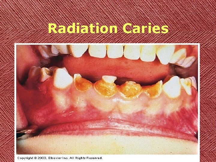 Radiation Caries 