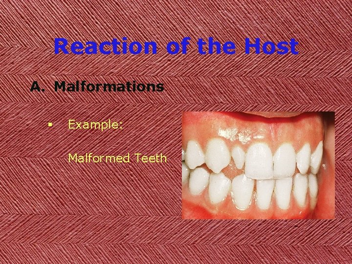 Reaction of the Host A. Malformations § Example: Malformed Teeth 