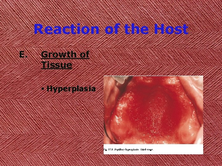 Reaction of the Host E. Growth of Tissue § Hyperplasia 