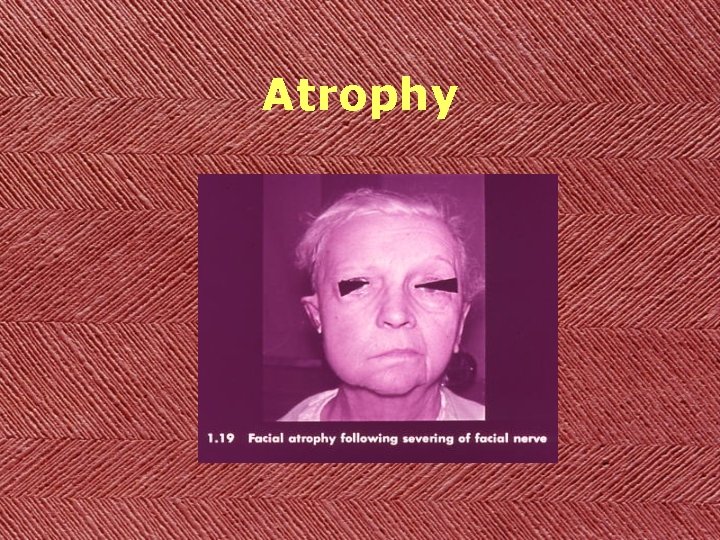 Atrophy 