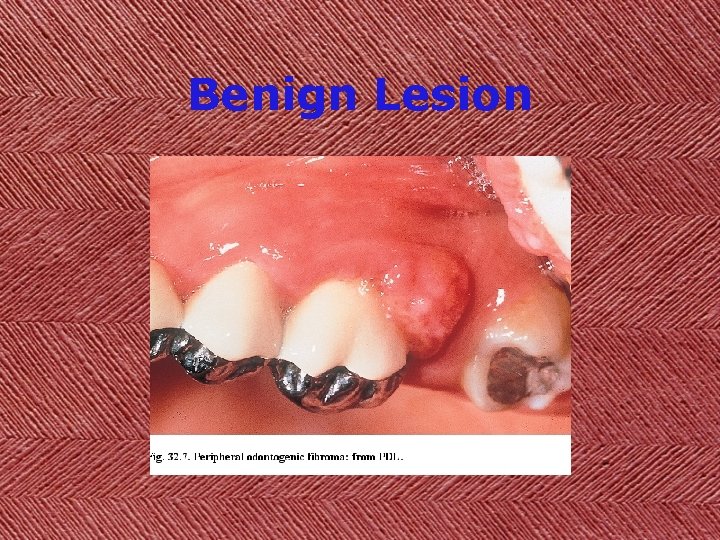 Benign Lesion 