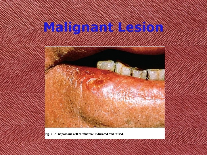 Malignant Lesion 