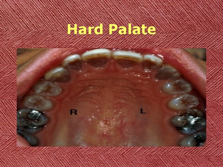 Hard Palate 