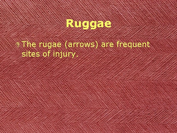 Ruggae D The rugae (arrows) are frequent sites of injury. 