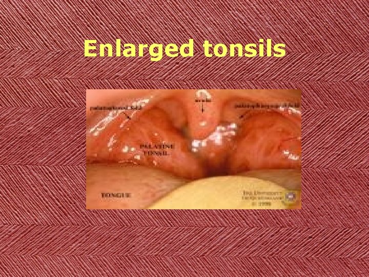 Enlarged tonsils 