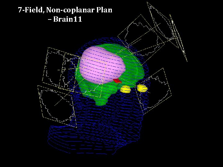 7 -Field, Non-coplanar Plan – Brain 11 