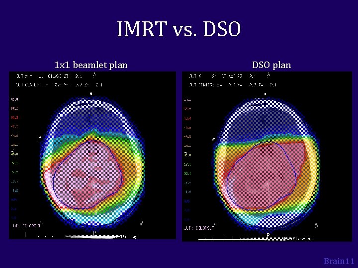 IMRT vs. DSO 1 x 1 beamlet plan DSO plan Brain 11 