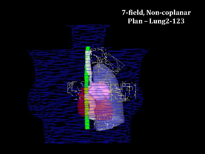 7 -field, Non-coplanar Plan – Lung 2 -123 