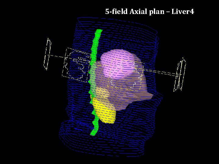 5 -field Axial plan – Liver 4 