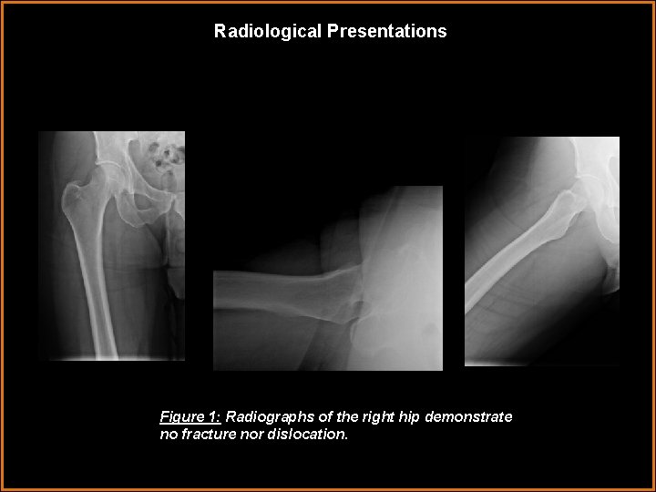 Radiological Presentations Figure 1: Radiographs of the right hip demonstrate no fracture nor dislocation.