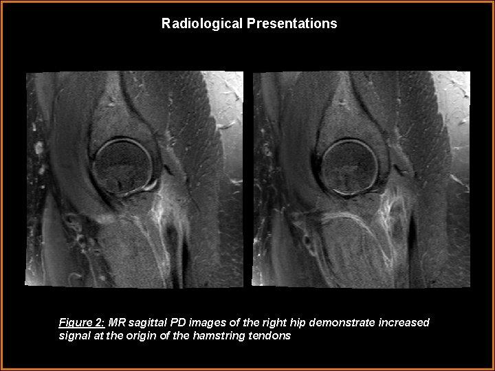 Radiological Presentations Figure 2: MR sagittal PD images of the right hip demonstrate increased