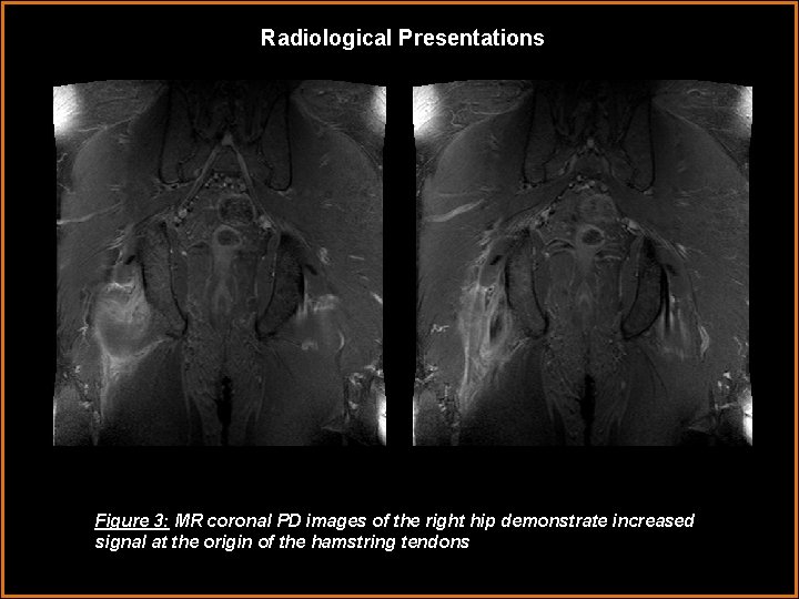 Radiological Presentations Figure 3: MR coronal PD images of the right hip demonstrate increased