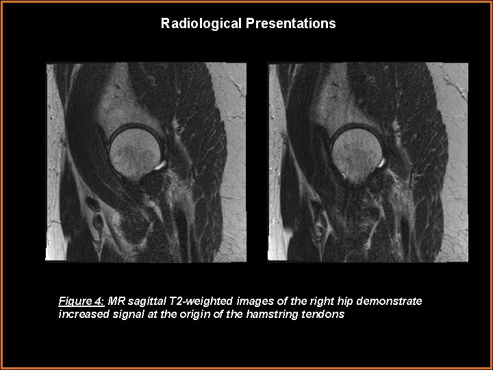 Radiological Presentations Figure 4: MR sagittal T 2 -weighted images of the right hip