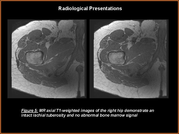 Radiological Presentations Figure 5: MR axial T 1 -weighted images of the right hip