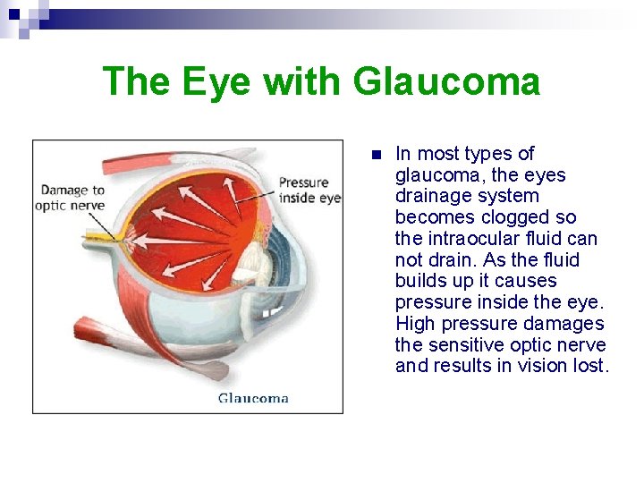 The Eye with Glaucoma n In most types of glaucoma, the eyes drainage system