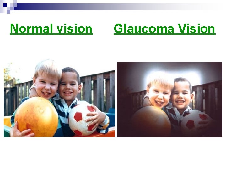 Normal vision Glaucoma Vision 