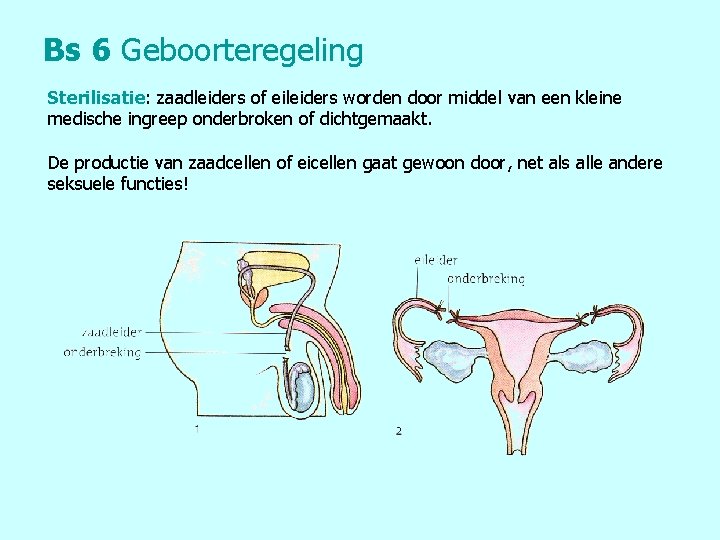 Bs 6 Geboorteregeling Sterilisatie: zaadleiders of eileiders worden door middel van een kleine medische