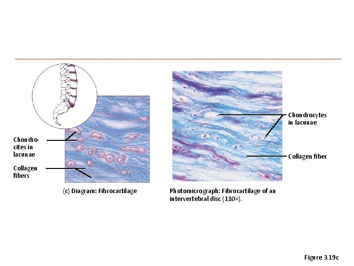 Chondrocytes in lacunae Chondrocites in lacunae Collagen fibers (c) Diagram: Fibrocartilage Photomicrograph: Fibrocartilage of
