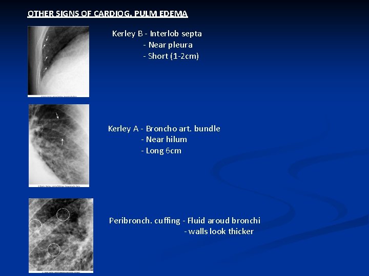 OTHER SIGNS OF CARDIOG. PULM EDEMA Kerley B - Interlob septa - Near pleura