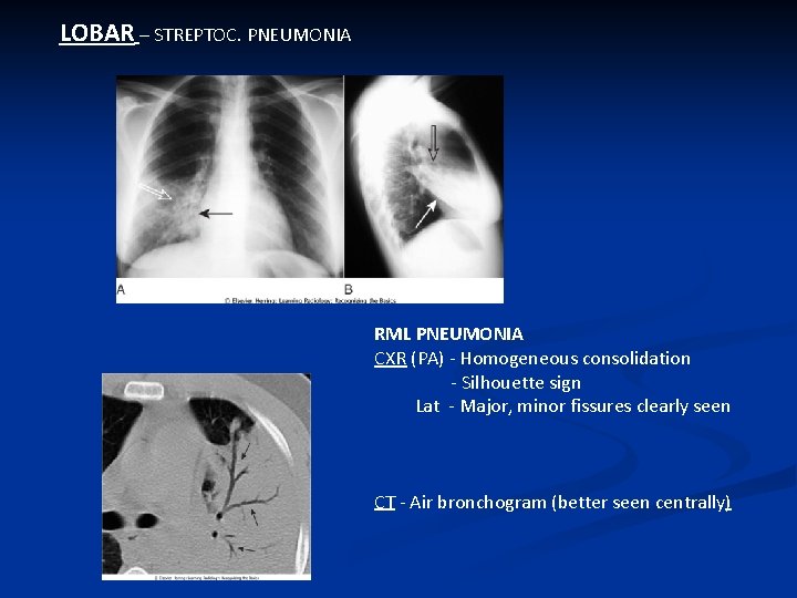 LOBAR – STREPTOC. PNEUMONIA RML PNEUMONIA CXR (PA) - Homogeneous consolidation - Silhouette sign