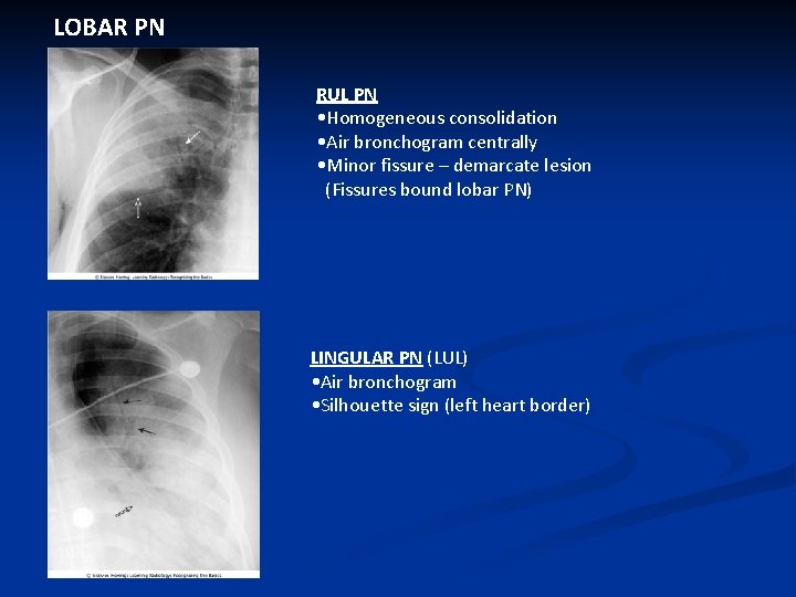 LOBAR PN RUL PN • Homogeneous consolidation • Air bronchogram centrally • Minor fissure