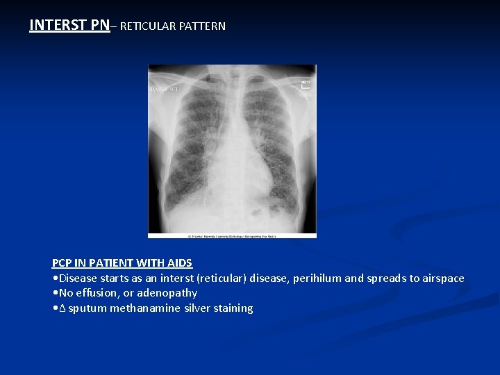 INTERST PN– RETICULAR PATTERN PCP IN PATIENT WITH AIDS • Disease starts as an