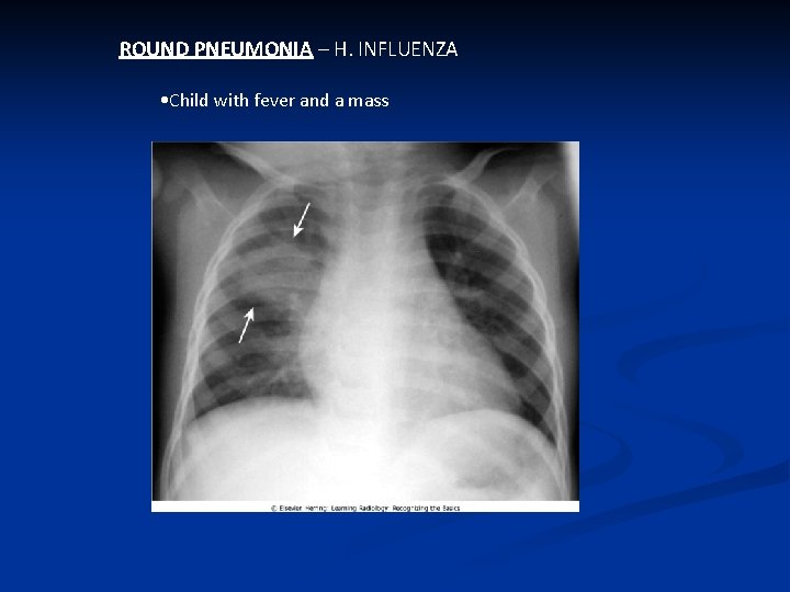 ROUND PNEUMONIA – H. INFLUENZA • Child with fever and a mass 