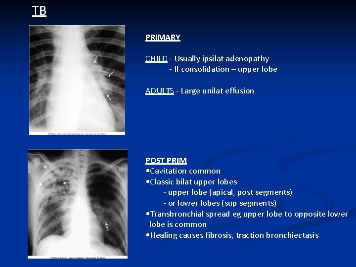 TB PRIMARY CHILD - Usually ipsilat adenopathy - If consolidation – upper lobe ADULTS