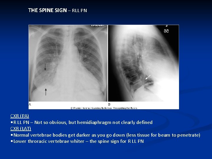 THE SPINE SIGN – RLL PN CXR (PA) • R LL PN – Not