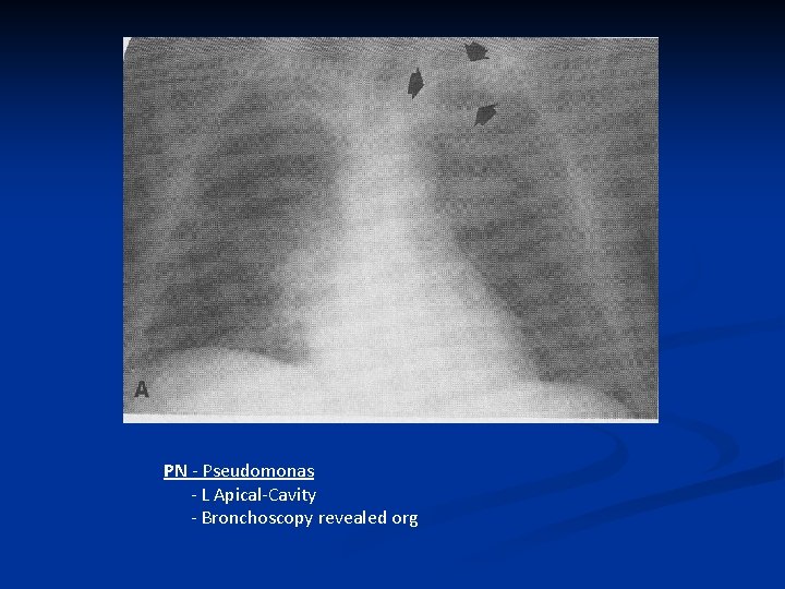 PN - Pseudomonas - L Apical-Cavity - Bronchoscopy revealed org 