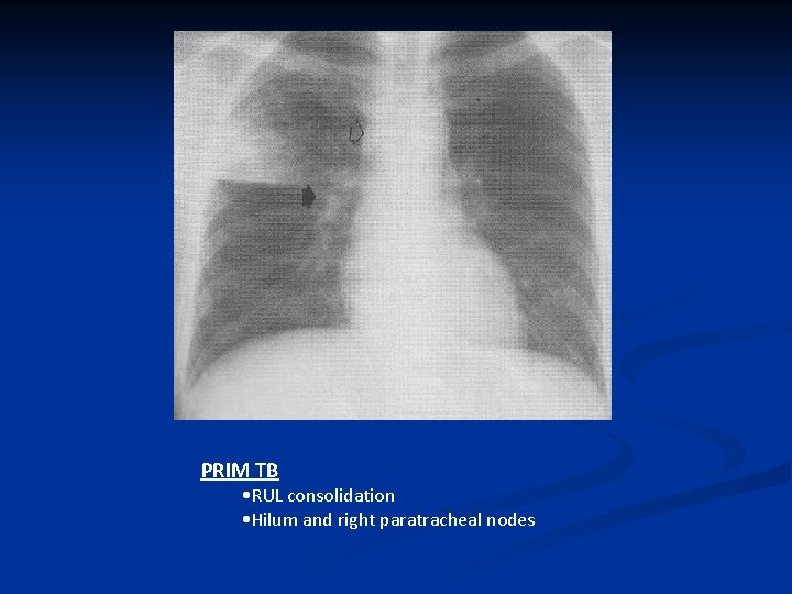 PRIM TB • RUL consolidation • Hilum and right paratracheal nodes 
