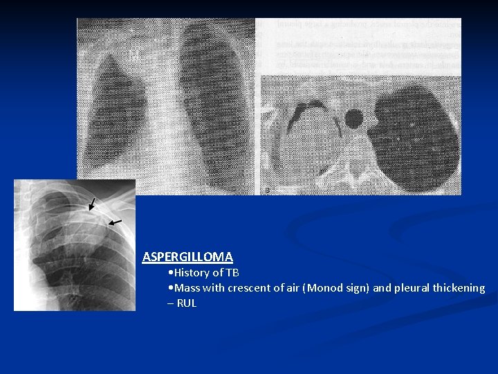 ASPERGILLOMA • History of TB • Mass with crescent of air (Monod sign) and