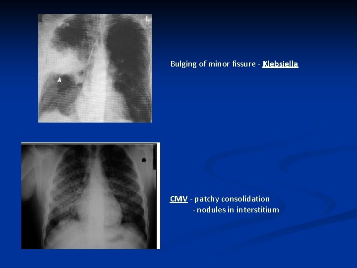 Bulging of minor fissure - Klebsiella CMV - patchy consolidation - nodules in interstitium