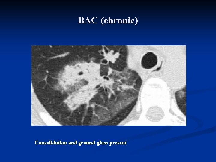BAC (chronic) Consolidation and ground-glass present 