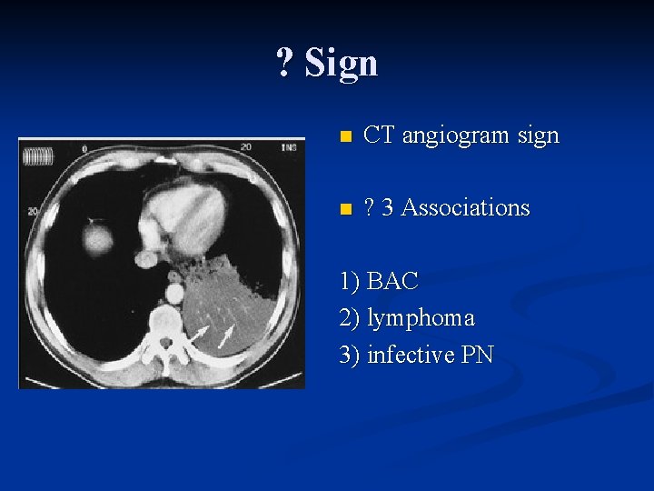 ? Sign n CT angiogram sign n ? 3 Associations 1) BAC 2) lymphoma