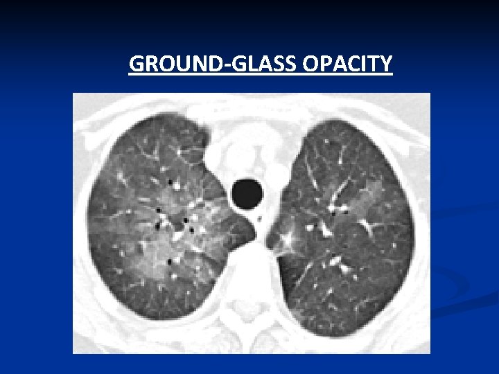 GROUND-GLASS OPACITY 