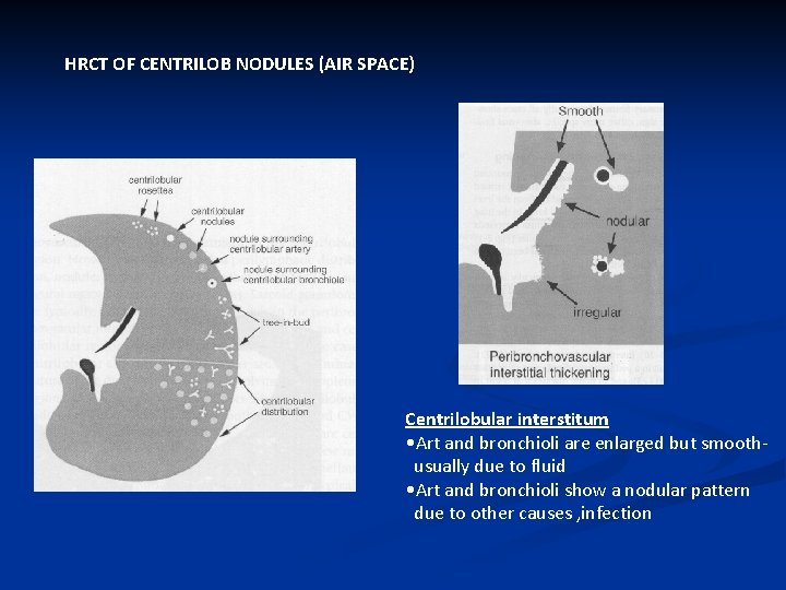 HRCT OF CENTRILOB NODULES (AIR SPACE) Centrilobular interstitum • Art and bronchioli are enlarged